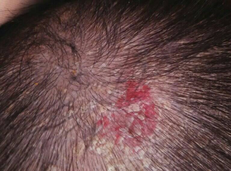 头皮血管瘤初期图片