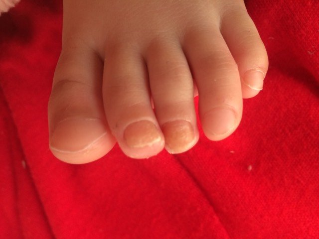 小孩脚指甲是怎么回事?
