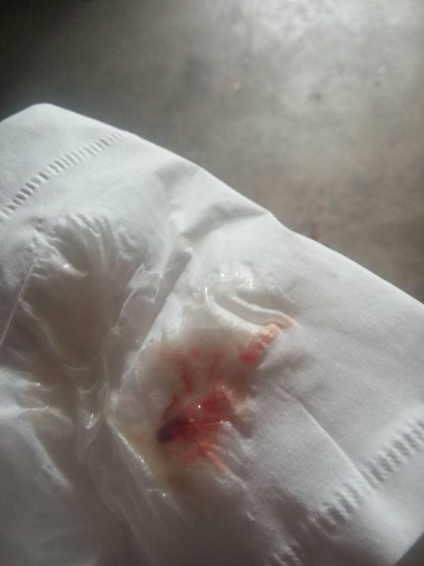 感冒流鼻涕出来有血