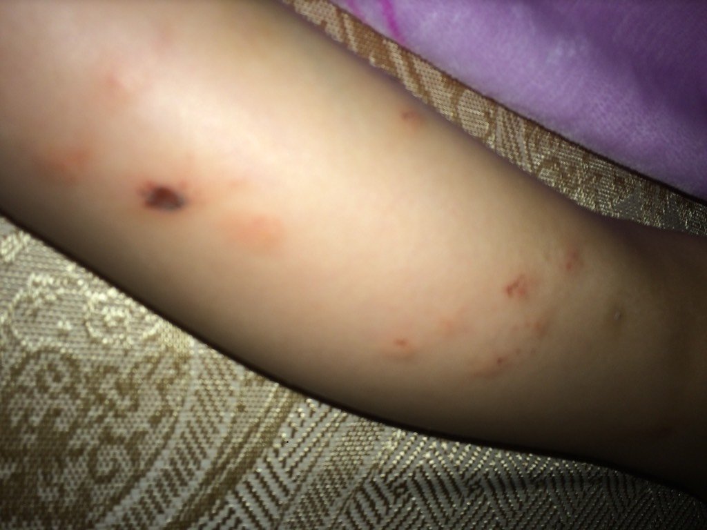 就痒得很,这是怎么回事,打针都没用 为您推荐: 其他回答 是不是过敏了