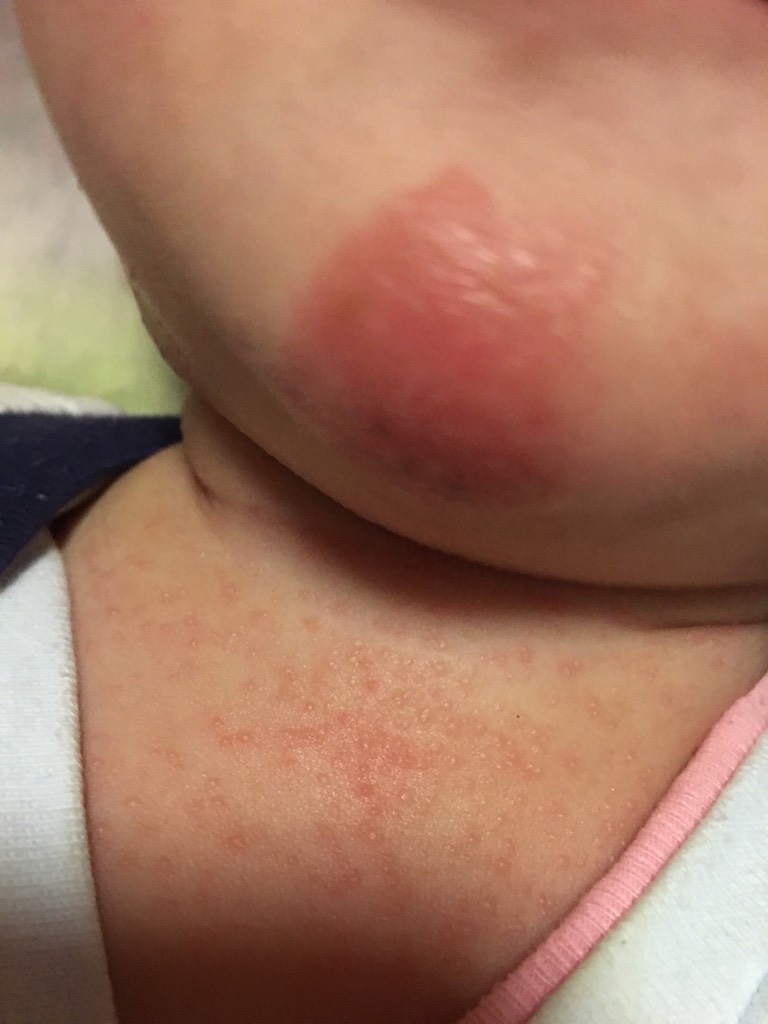 宝宝这个下巴和头颈里的是湿疹吗,怎么护理控制和治疗呀?