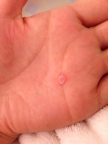 2010年得过梅毒三期,一直打针治疗,后来没有复查,一直也没有复发,我