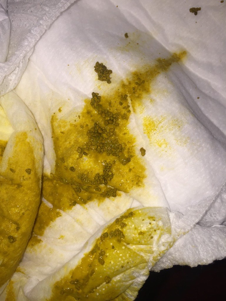 53天女宝宝,大便里面有很多颗粒,很硬不知道是什么