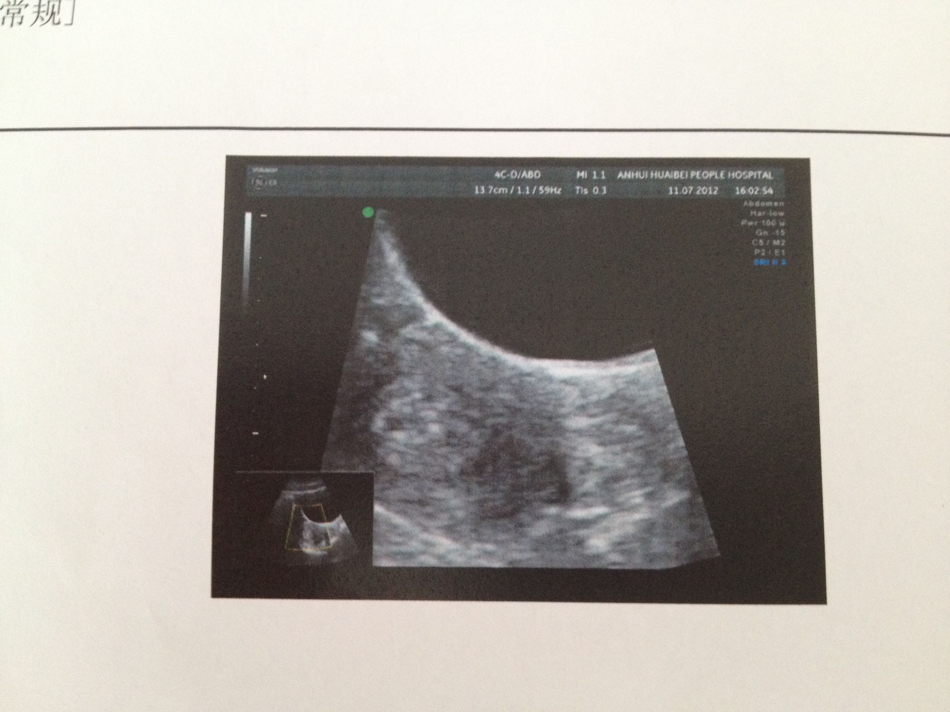 b超检查两个孕囊