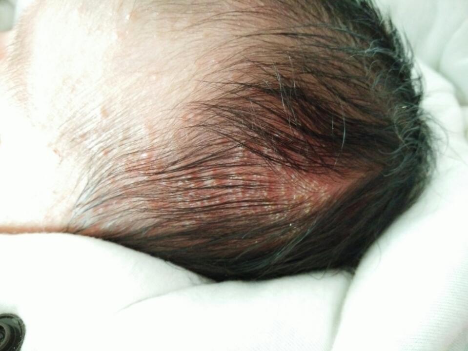 27天的宝宝头上长了好多像痘痘一样的是什么?怎么预防处理?