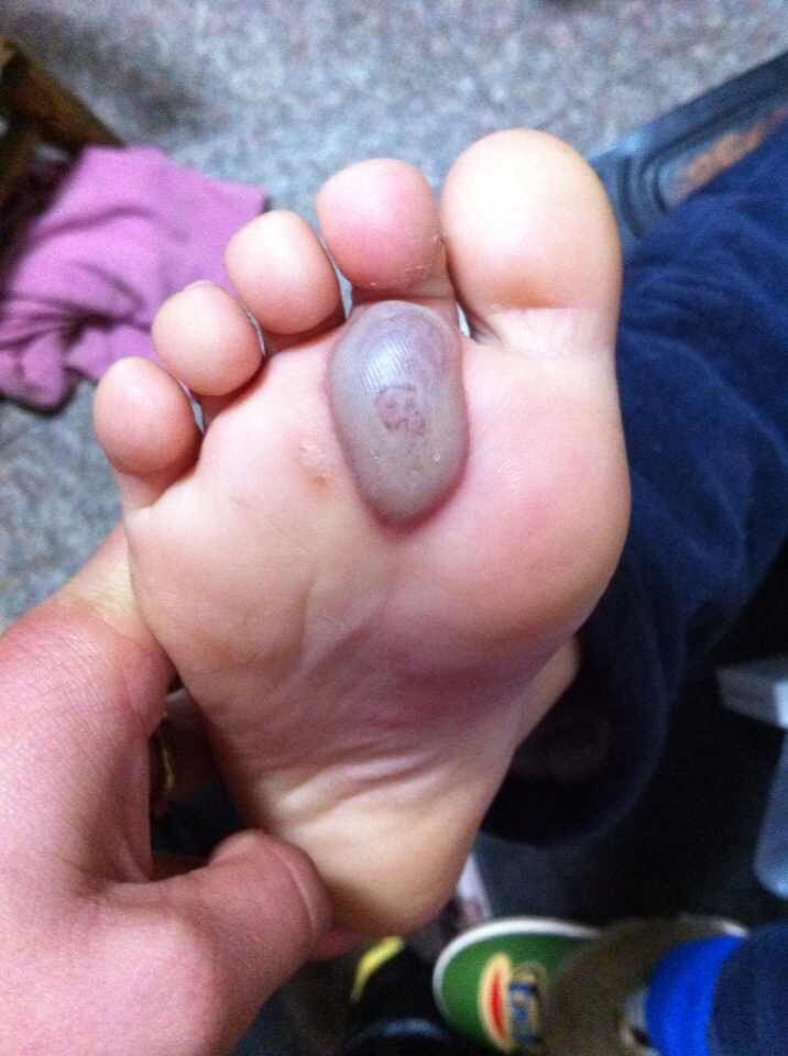 问:小孩子脚底出泡 腿上出现红片 是怎么回事?