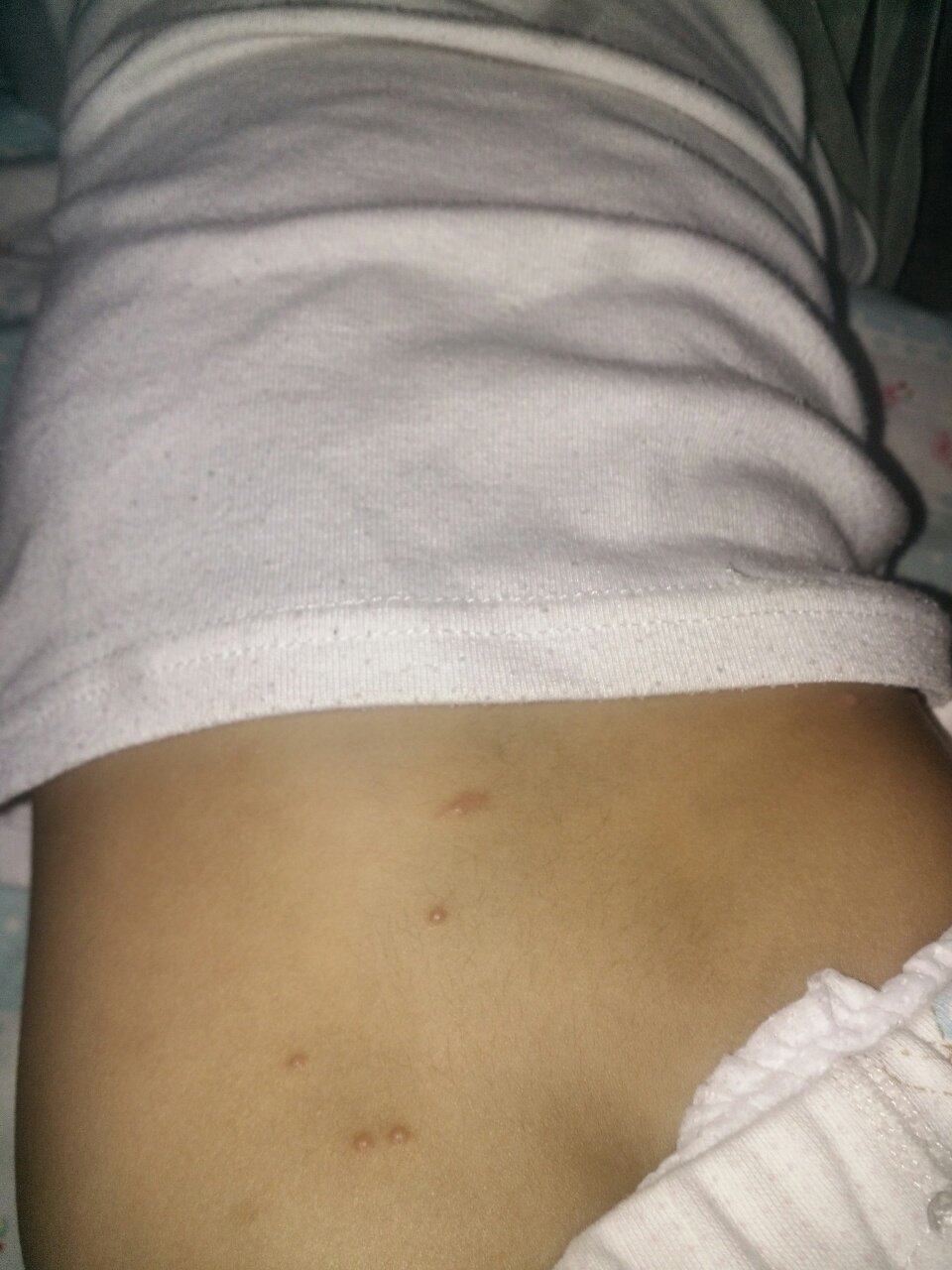 宝宝腰上腿上有很多痘痘怎么回事
