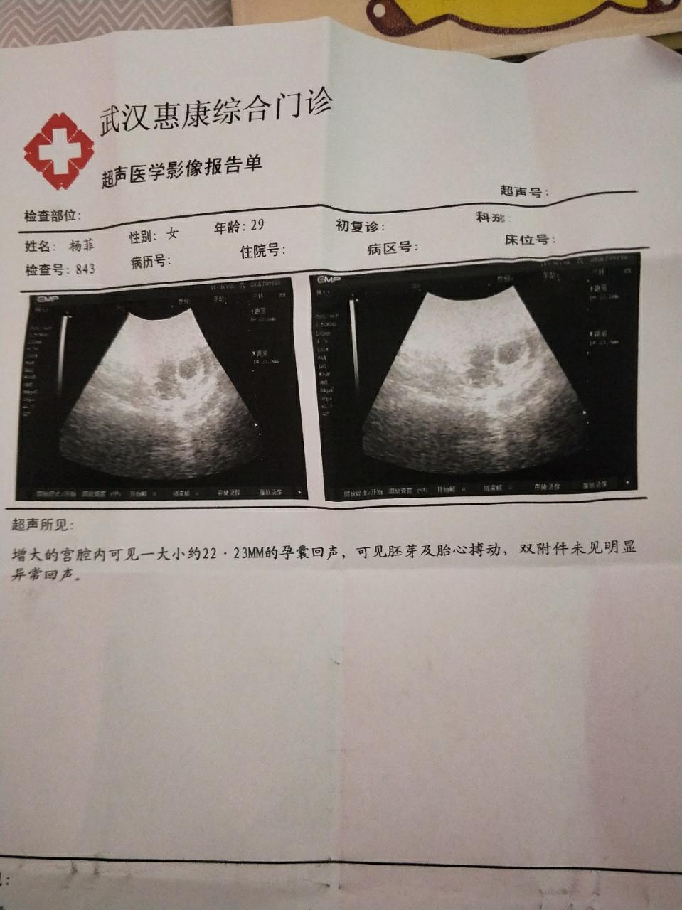 孕囊数据看男女准吗?