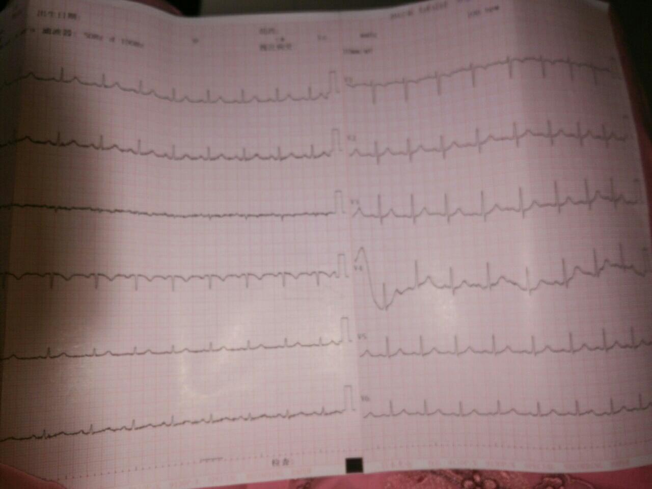 11 13楼 云清玛:我心电图心跳是107,你的多少?