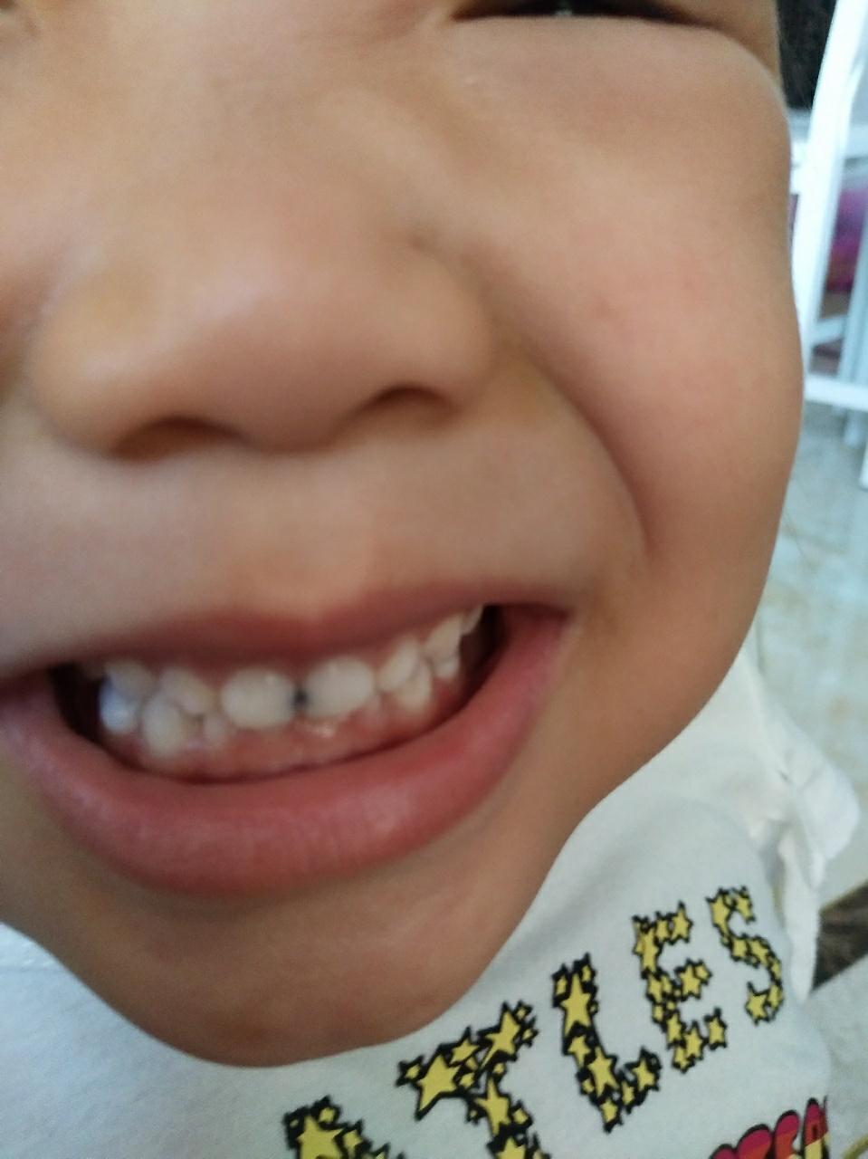 5岁的小孩,前面门牙中间缝隙有黑色的蛀牙,需要补牙吗?