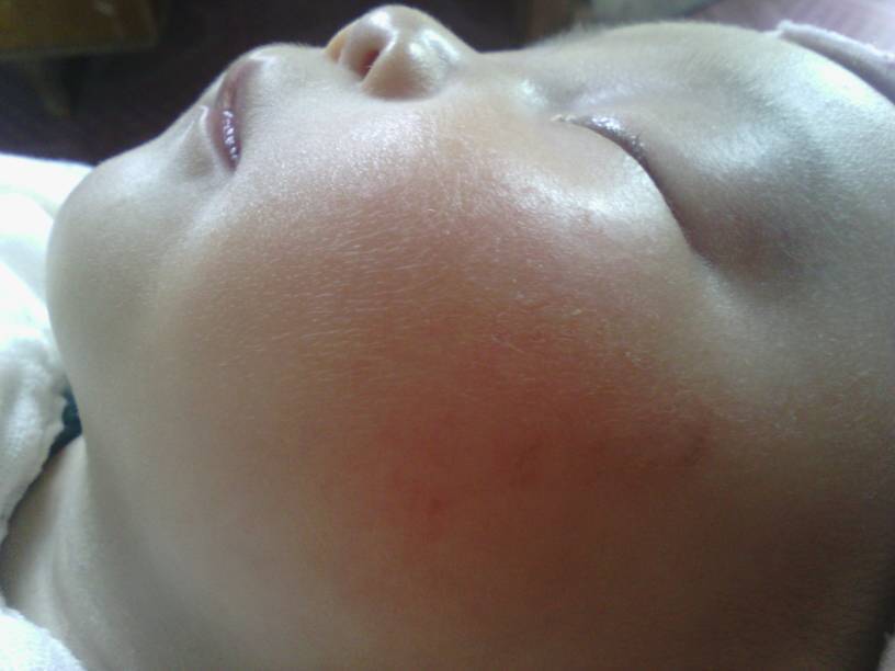 奶癣严重吗!用什么会好呢