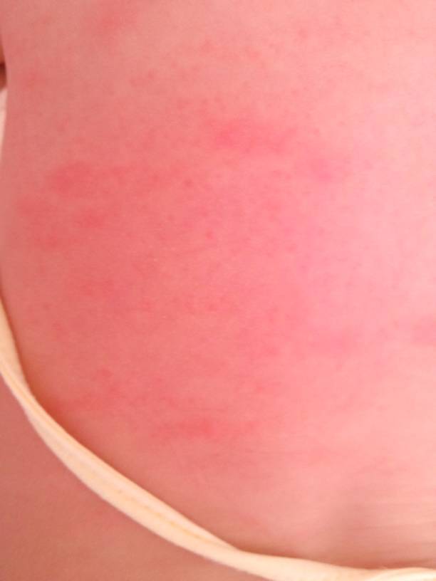 三个月宝宝后背这样是湿疹吗