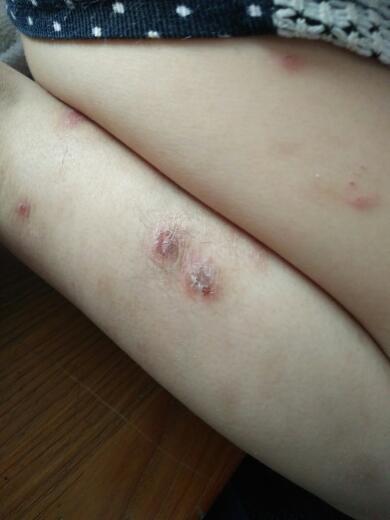 孩子腿上长疙瘩,看医生抹了药还不好,哪位大神知道是什么怎么治疗