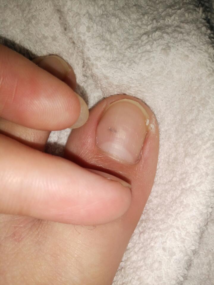 脚拇指的指甲里有黑黑的一小块是怎么回事?