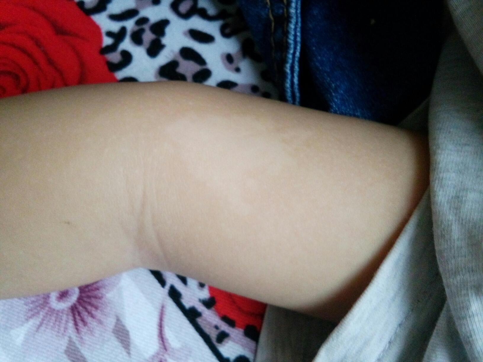 无色素痣求助 - 百度宝宝知道