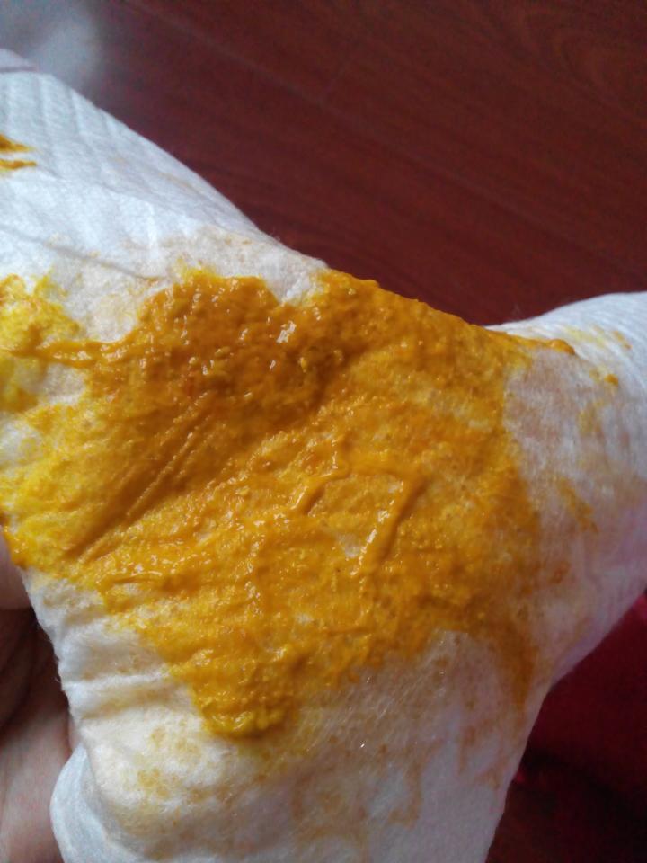 纯母乳喂养大便里有像面条一样细的粘液,带点点墨绿,而且有两条血丝