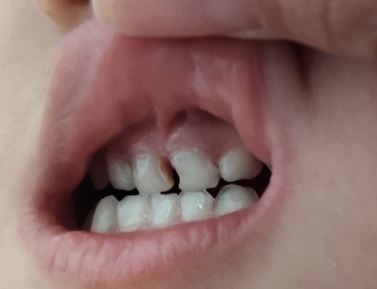 儿童门牙中间有个小洞图片