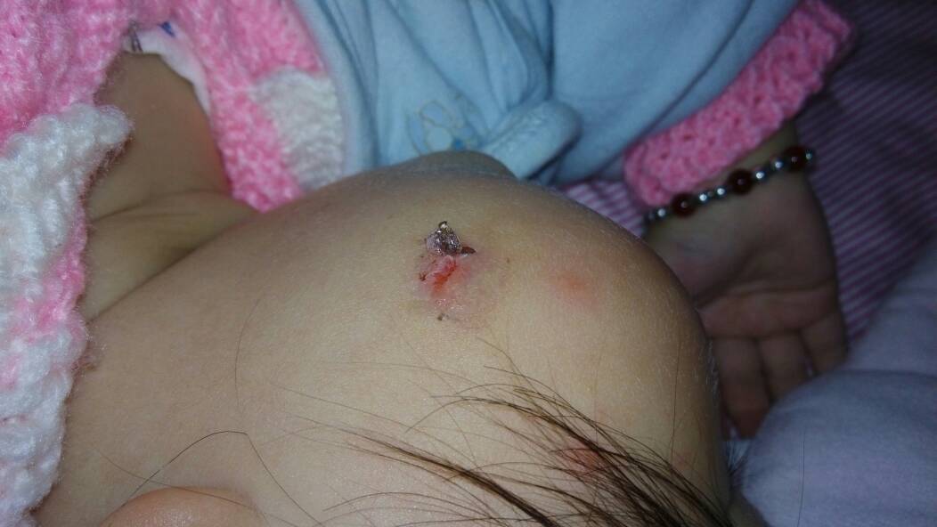 一岁宝宝被小孩咬到了会不会留下疤痕呀好心痛哦