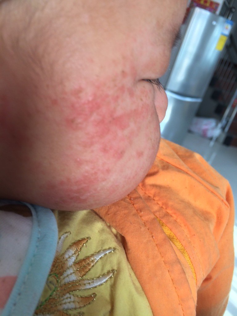 宝宝十几天就出现湿疹,马上快要4个月了,湿疹变得严重了 期间用了两种