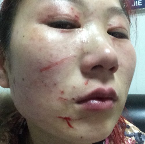 脸让对方抓伤了,宝宝眼角也有口子,能让对方拘留和赔偿吗?