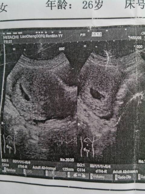 怀孕44天孕囊24