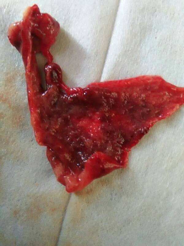 所说的肉肉的胎囊流出来,医院是没有发现胚牙的,所以未发现胚胎组织