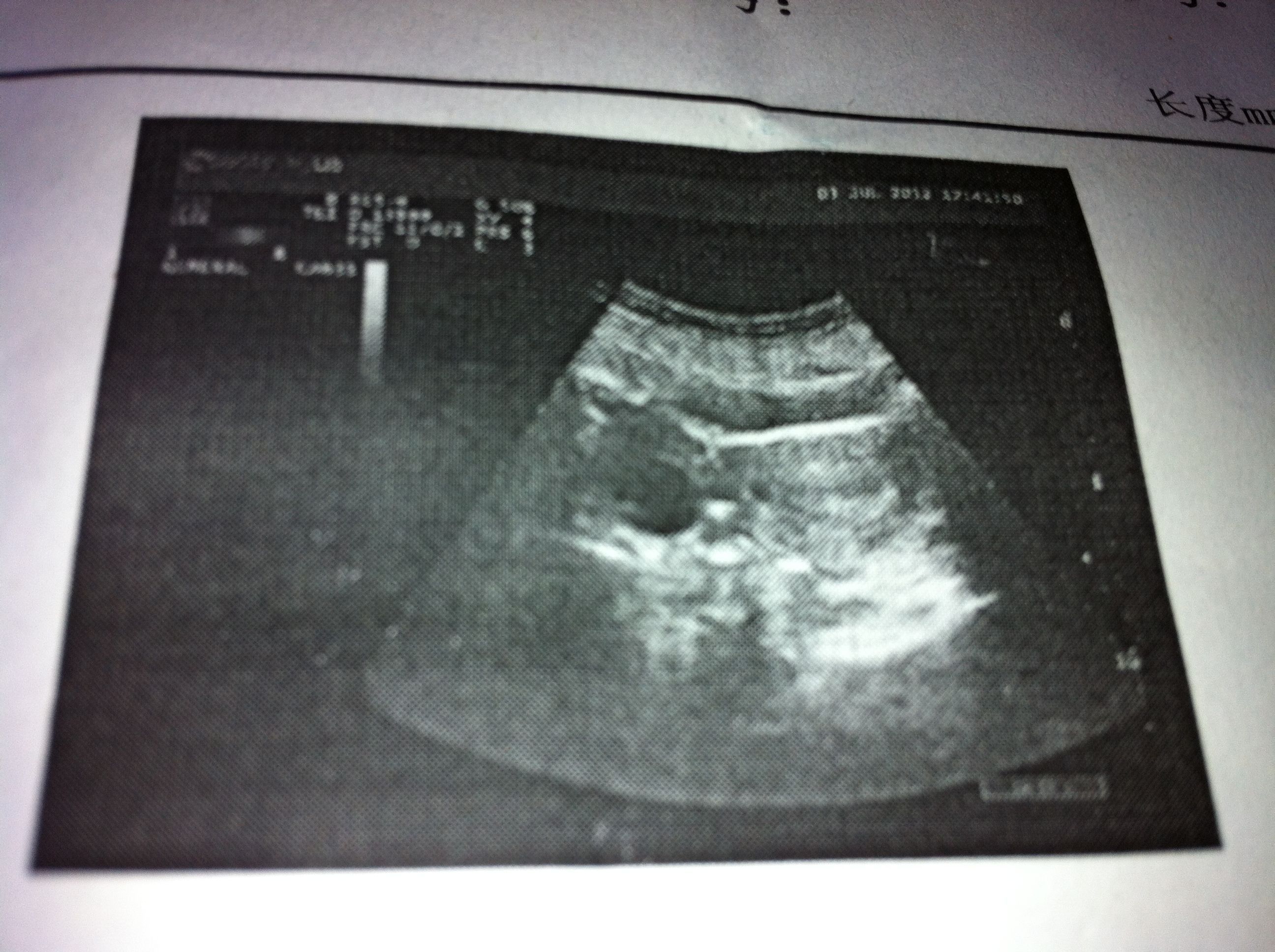 子宫内膜的厚薄与怀孕之间的关系