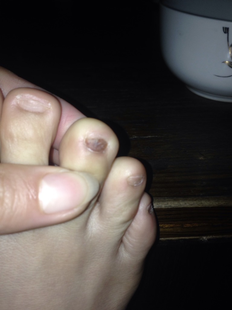 突然发现脚趾黑黑的,大概有两个月了,请问是灰指甲嘛?