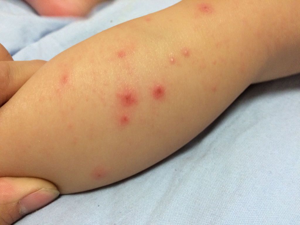 宝宝1岁2个月了,小女孩,最近身上出了很多小豆豆腿