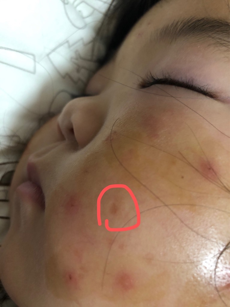 现在三岁了,这些痘坑痘印还是不见好,是不是会永远留在脸上了啊?