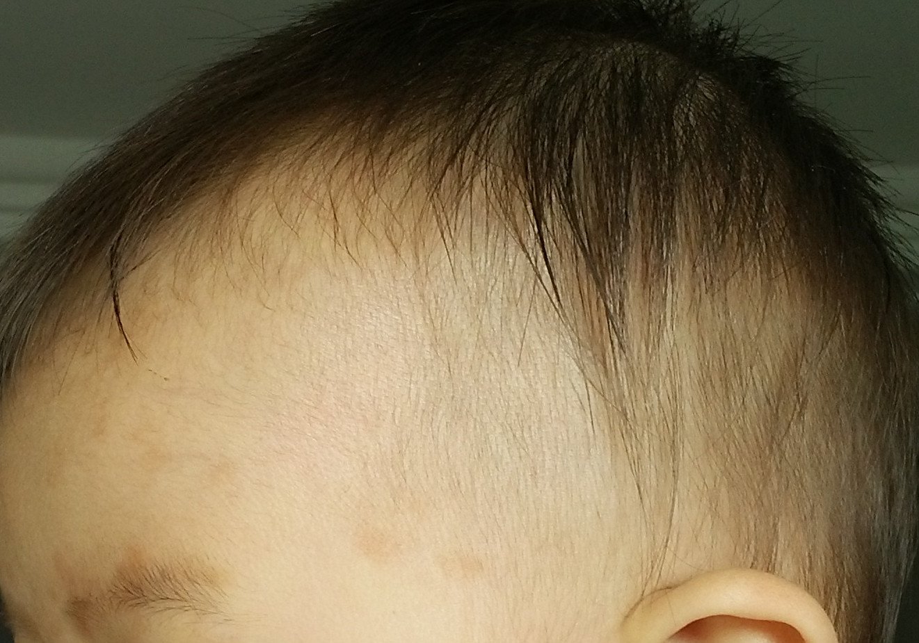 婴儿脸上红斑，出生到现在7个月大，该处红斑从出生到现在一直未消退 - 百度宝宝知道
