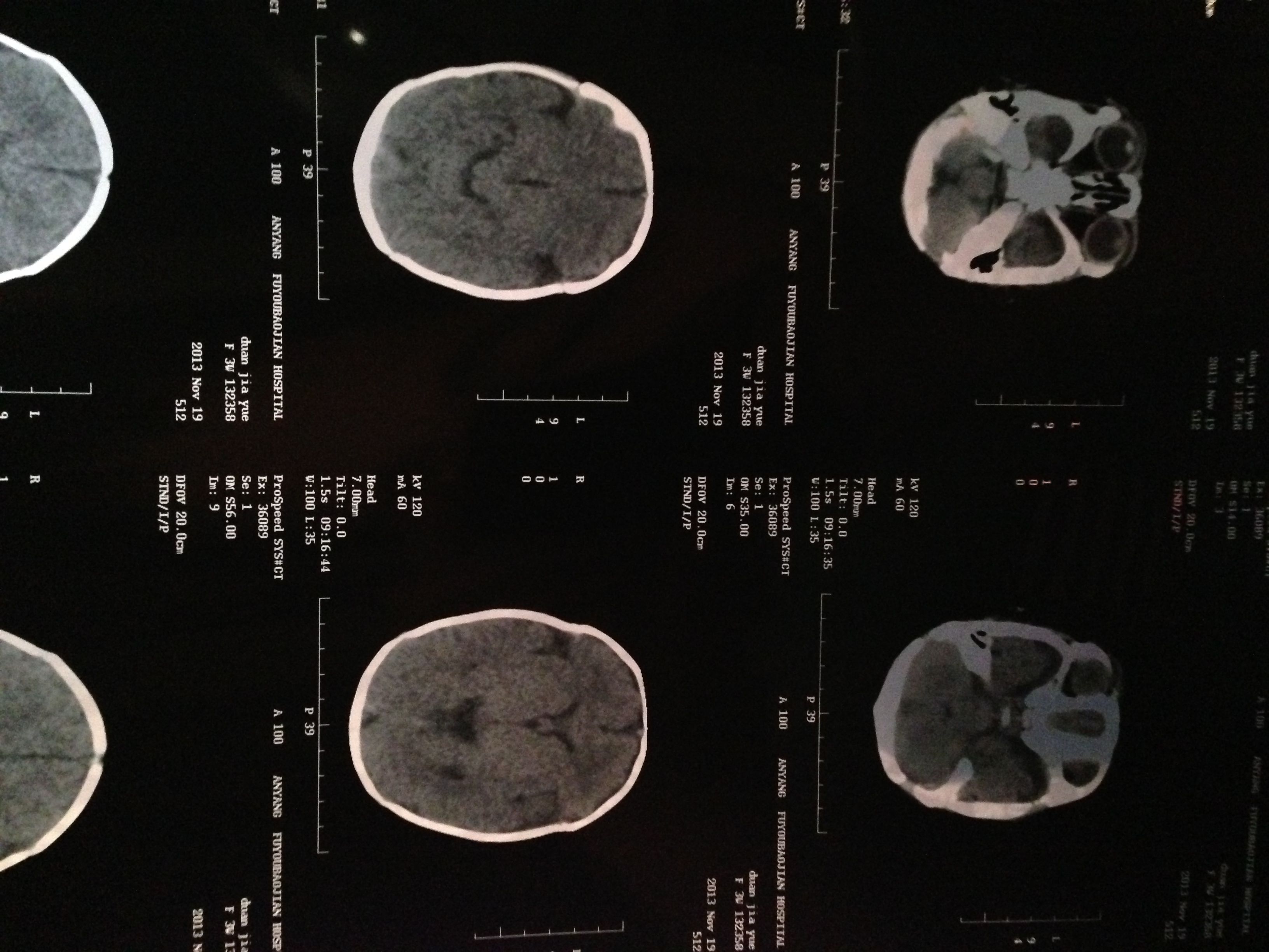 四、眼内容物-眼眶病磁共振(MRI)诊断-医学