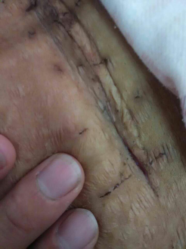 子宫肌瘤手术刀疤图片