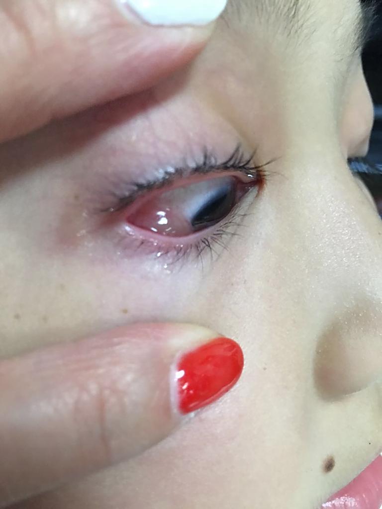 问答 问答首页  满意回答 突然出现的要考虑是水肿导致的,有没有眼睛