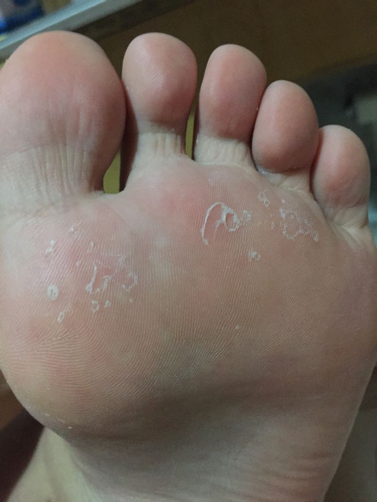 脚底下脱皮成这样了,这是肿么回事…吓死宝宝了