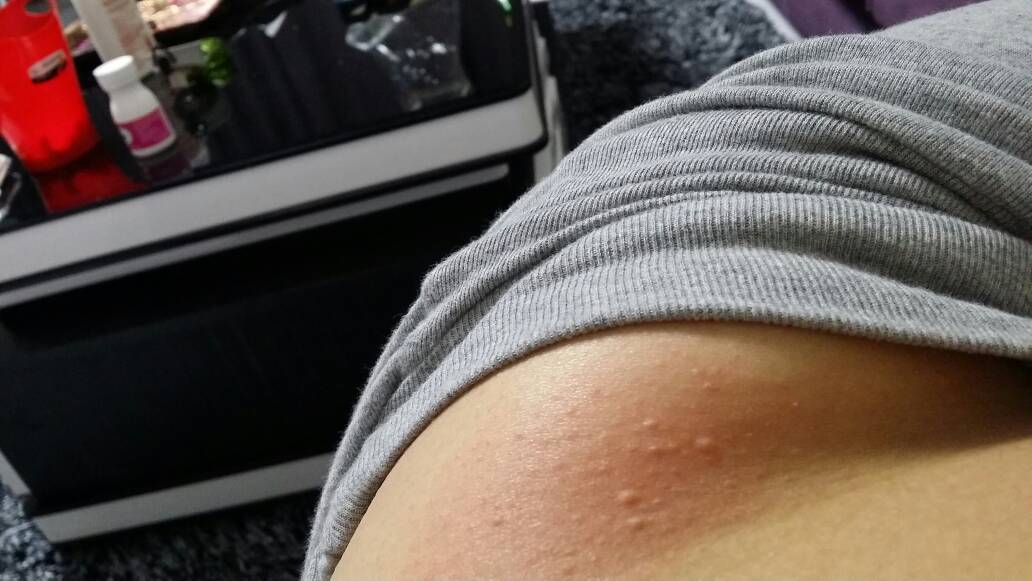 身上痒,后背痒,挠了就起嘎达,一会就下去