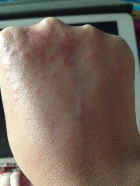 手上长了类似过敏的东西,有点痒,帮忙看看是什么?能用什么药?