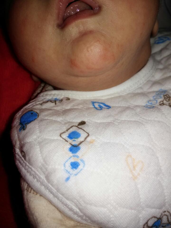 求解答,宝宝下巴一小块一小块红,是奶藓还是湿疹丫!宝宝已经26天了