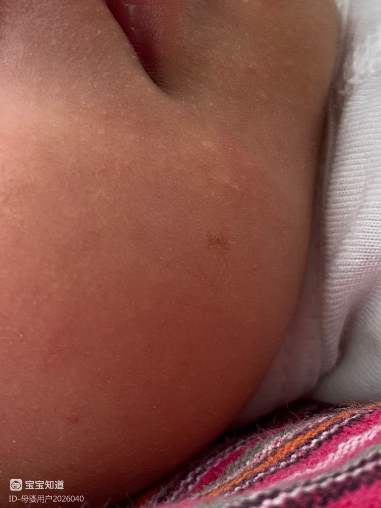 婴儿脸上褐色斑图片图片