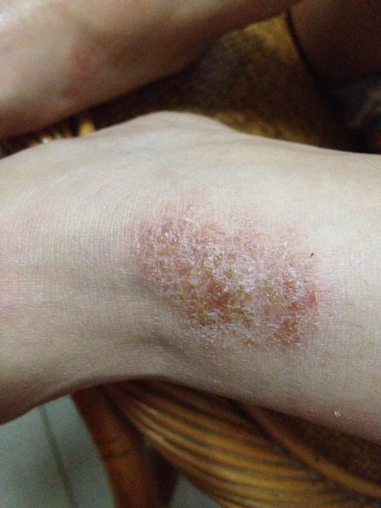 请问这脚上长的是什么东西,有一个多月了,越干燥越痒 有没什么药可以