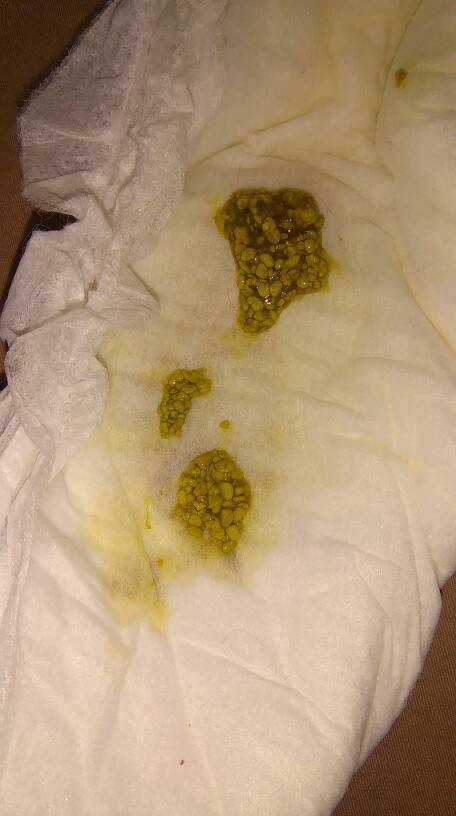 宝宝出生第四天了,这样的大便正常吗?