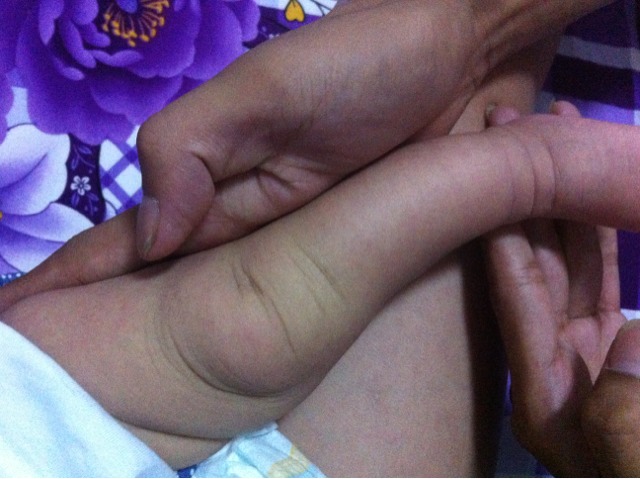 1岁宝宝罗圈腿自测图片